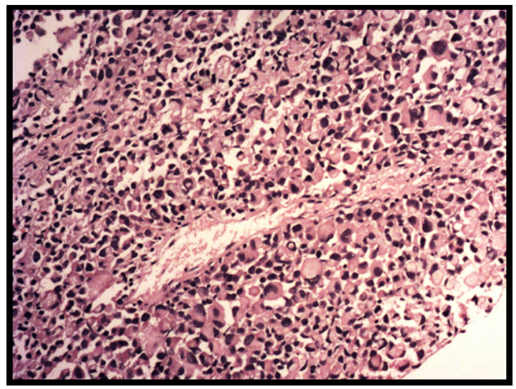 Figure 4 from Signet-ring prostatic carcinoma. Case presentation and review  of the literature. | Semantic Scholar