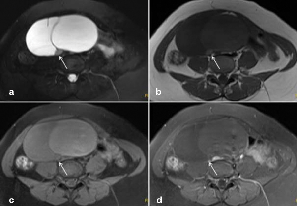 JCDR - Huge ovarian cyst, Laparoscopy, Young woman