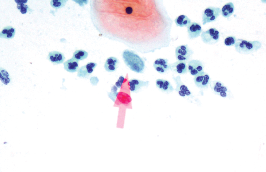 papilloma fedele icd 10 talán a papilloma vírus