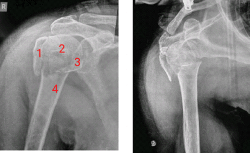 The Marchetti–Vincenzi humeral nail—a useful device in fresh fractures -  ScienceDirect