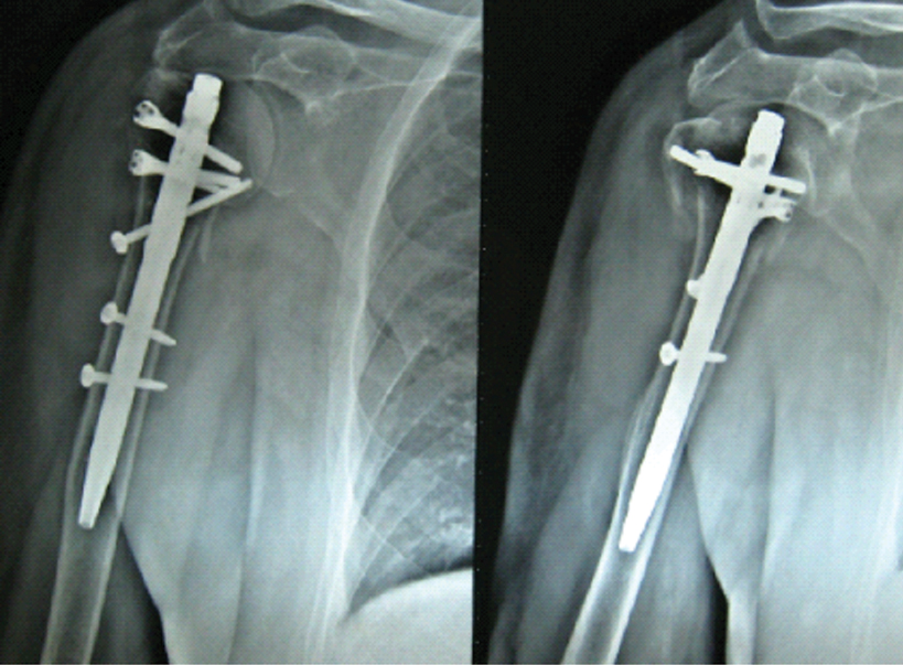 Solid Humerus Nail, Thickness: 2 Mm, Size: 9 Mm at Rs 1200 in Ahmedabad |  ID: 22588165912