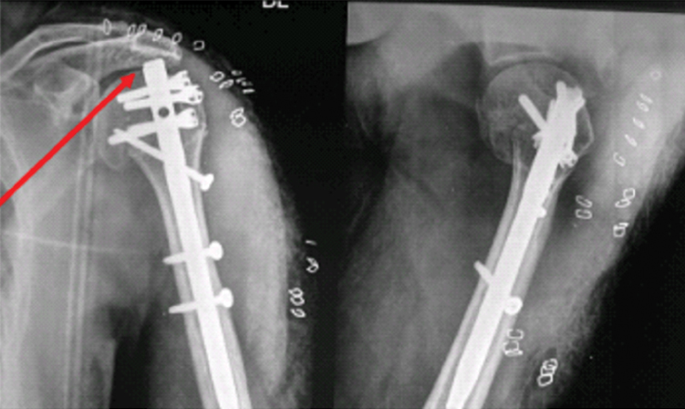Humeral intramedullary nail - G-6304 - Suzhou Kangli Orthopaedics  Instrument - right / left / titanium