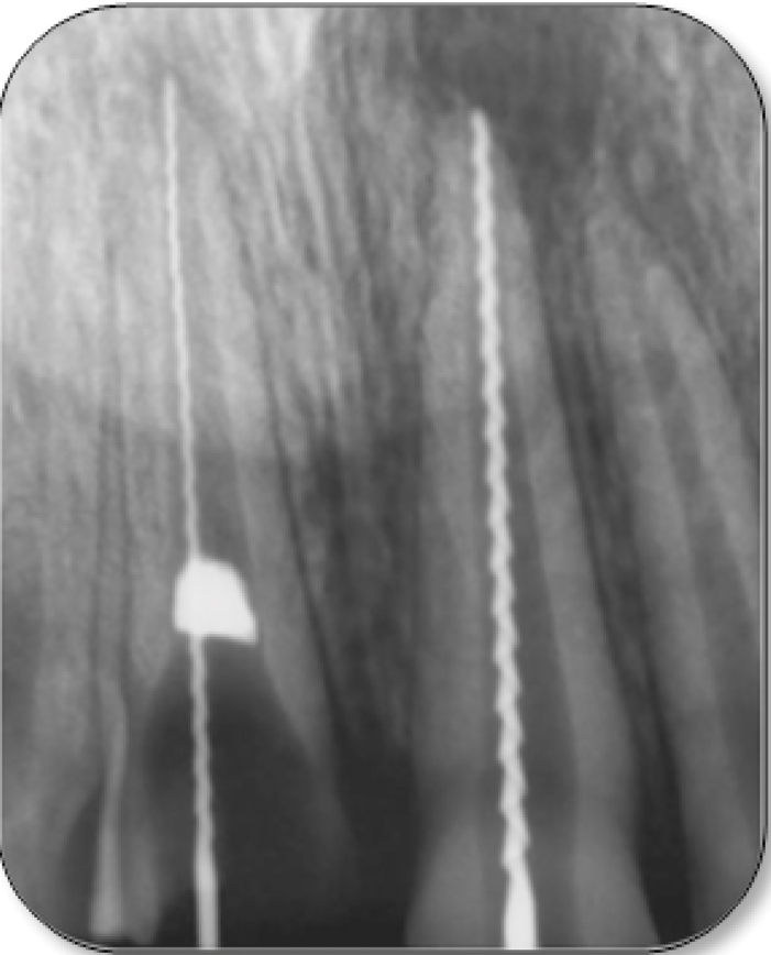 Glass Radiograph Retrieved foreign object (Glass piece) from tooth #11.