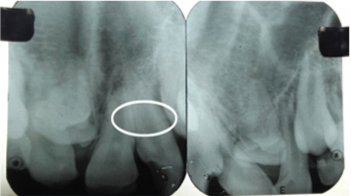 SLOB rule to confirm palatal location of denticles.