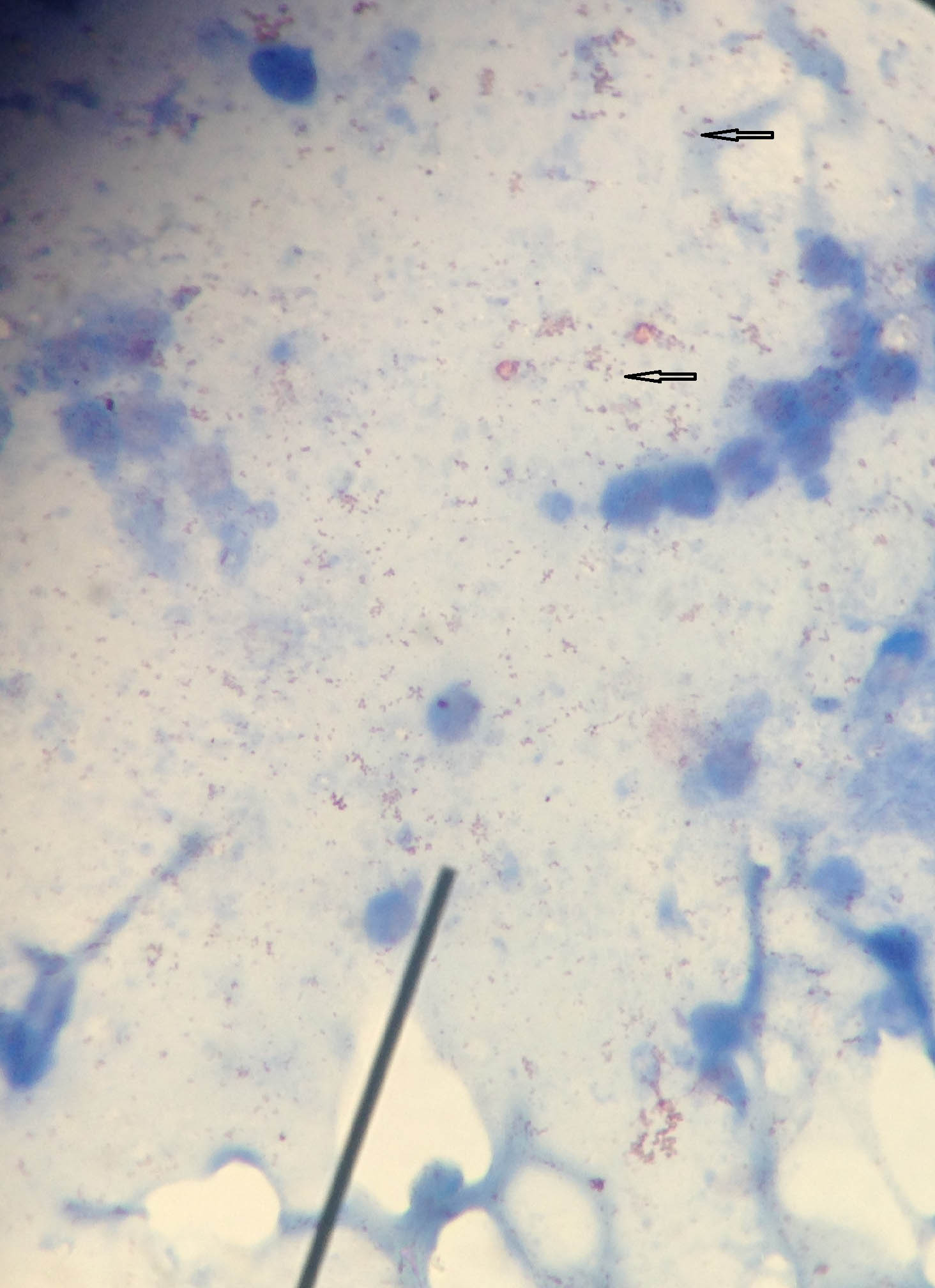 Ziehl-Neelsen stained smear of sputum sample showing various non ...