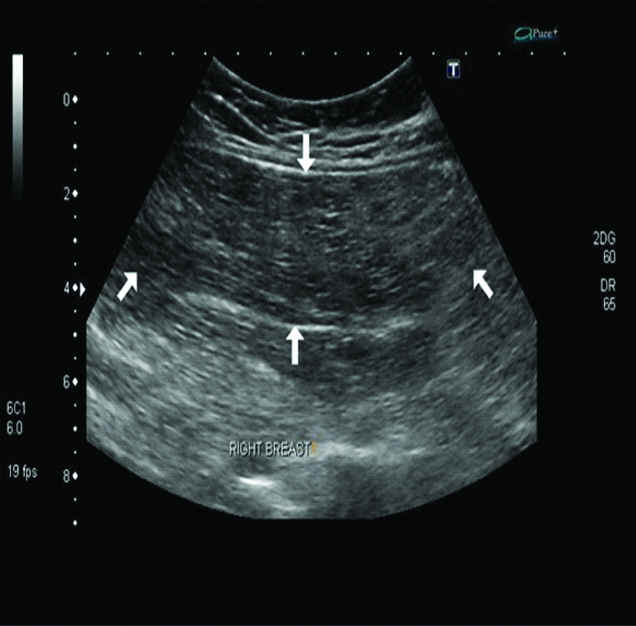 USG showed hyperechoic lesion in retromammary region, within the ...