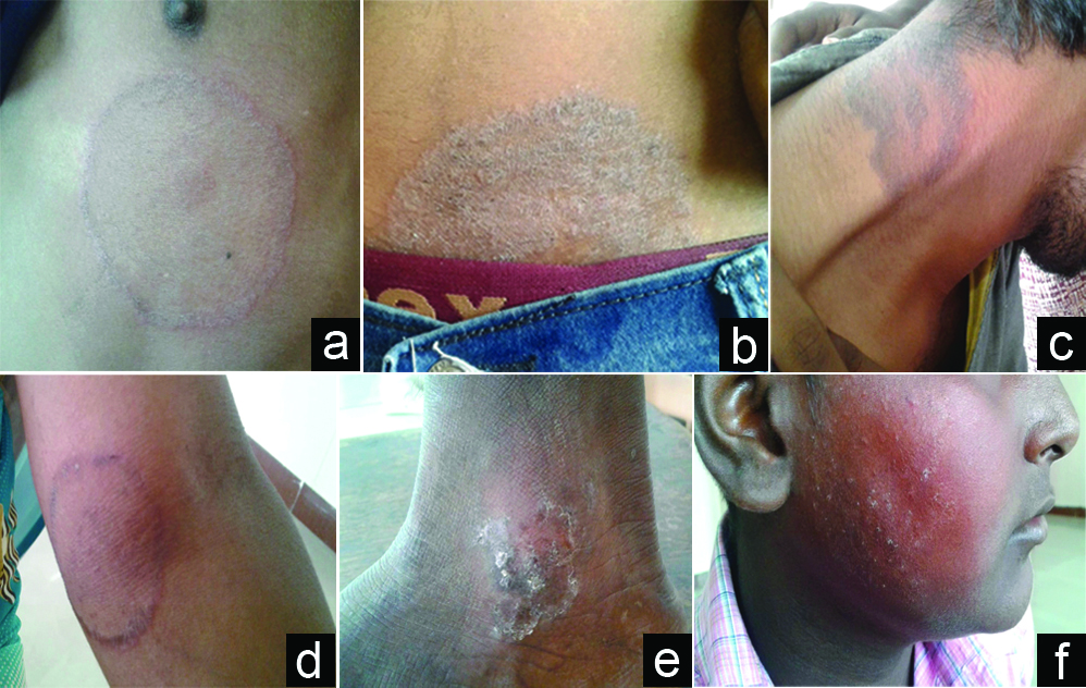 Tinea capitis in the pediatric population: A study from North India -  Indian Journal of Dermatology, Venereology and Leprology