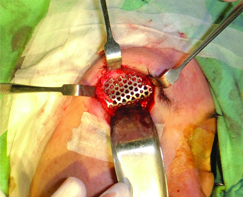 Table 1 from Alternative Treatment of Osteoma Using an Endoscopic  Holmium-YAG Laser