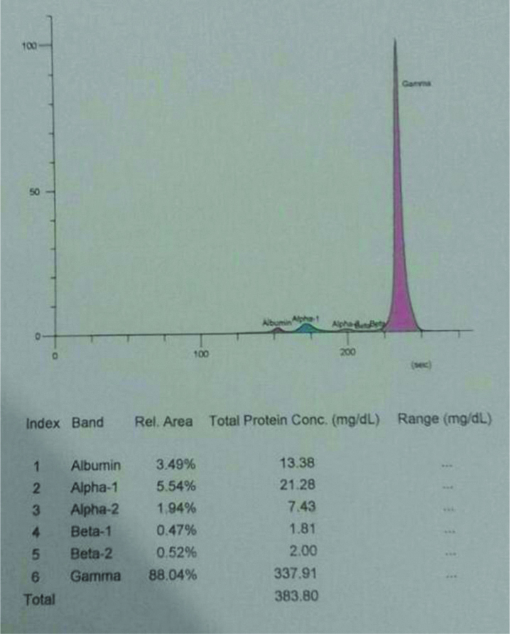Monoclonal protein was found in urine electrophoresis.