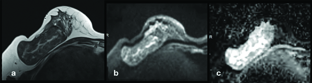 MRS in the hamartoma showed low choline values.
