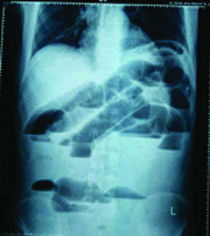 Plain abdominal radiograph- showing features of small bowel obstruction.