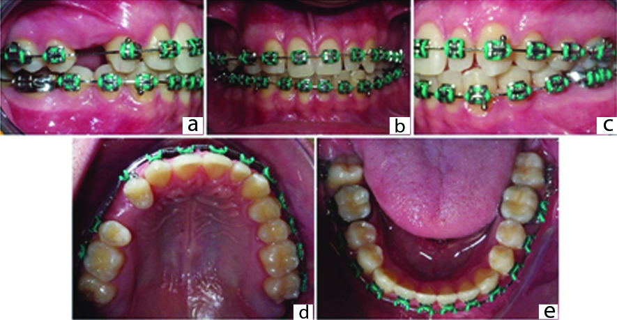 PDF) Effects of active and passive lacebacks on antero-posterior position  of maxillary first molars and central incisors