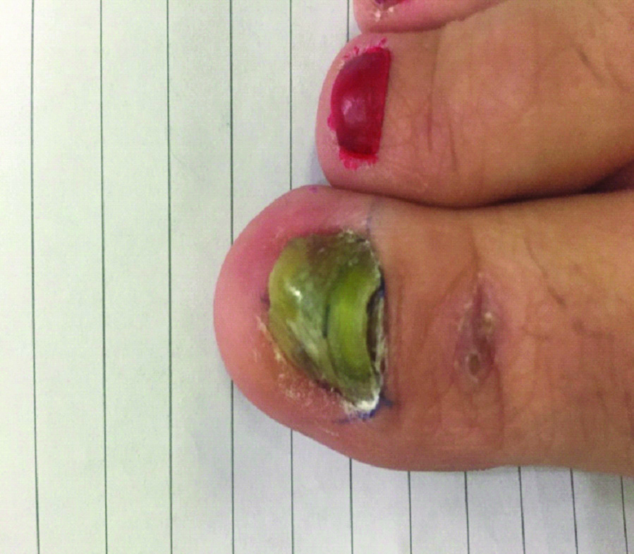 HOW TO TREAT FUNGAL NAIL INFECTION - TINEA UNGUIUM / ONYCHOMYCOSIS - YouTube