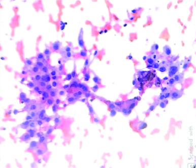 Epidermal Inclusion Cyst Cytology