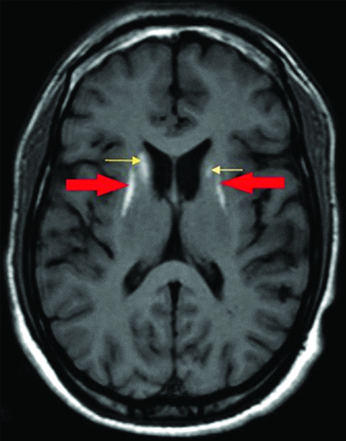 T1 weighed MRI of Brain showing bilateral symmetrical hyperintensities ...