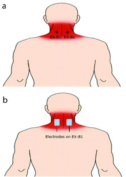 JCDR - Acu-transcutaneous electrical nerve stimulator, Coronavirus,  Physiotherapy, Physical therapy, Pulmonary