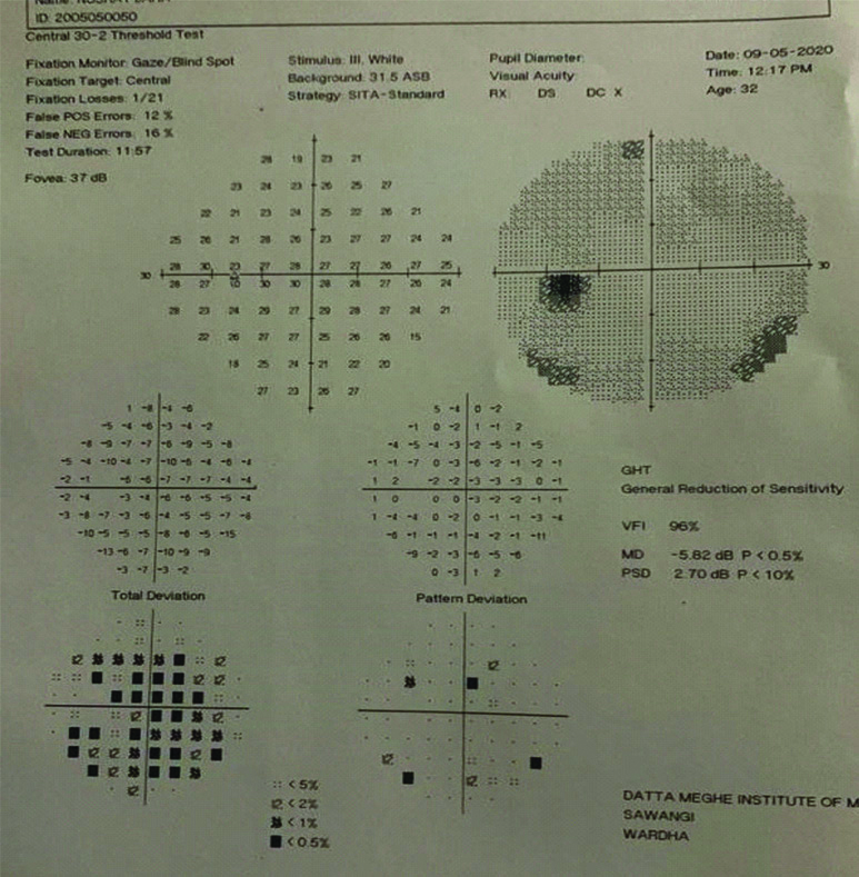 Fundus examination in right eye, disc was normal, no hyperemia or ...