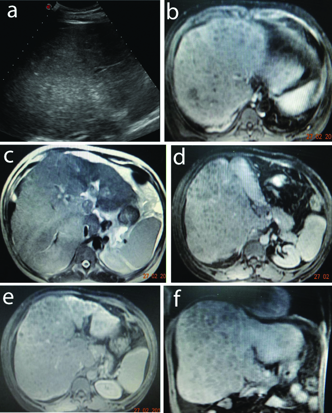 Nutmeg Liver Ultrasound