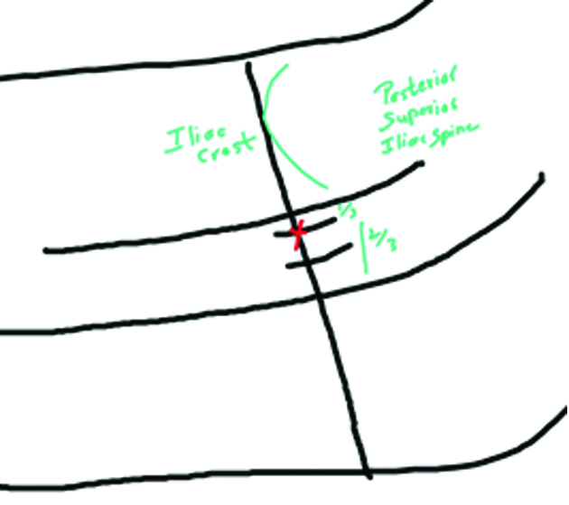 Landmark for lumbar plexus block. Red cross mark indicates point of ...