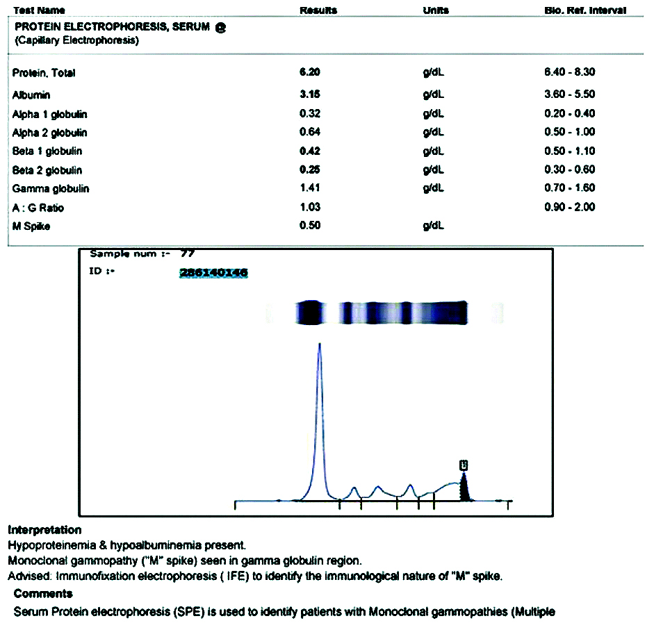 Serum protein electrophoresis showing M spike.