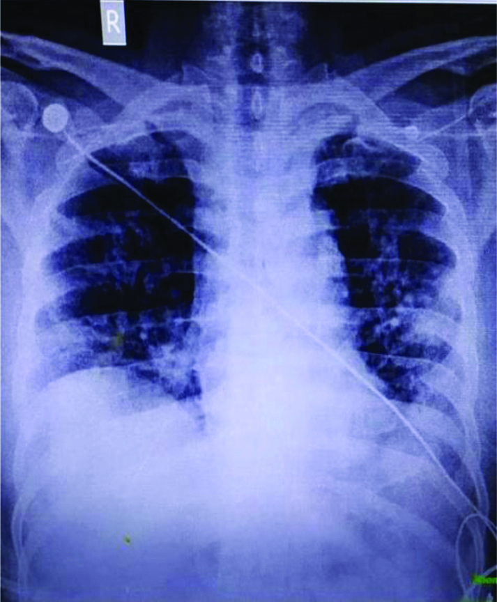 Axial view of HRCT chest.