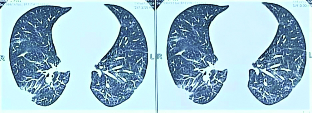 CT Chest done during repeat infection bilateral ground glass opacities ...