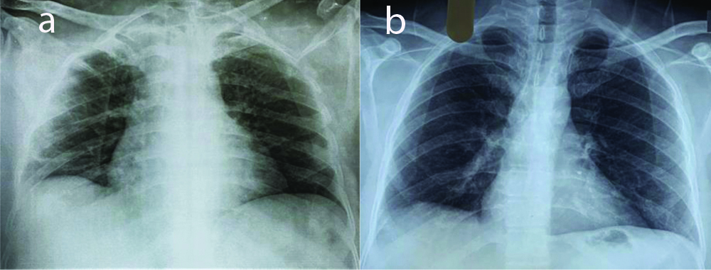 a) Chest X ray during first infection; b) Chest X ray during repeat ...