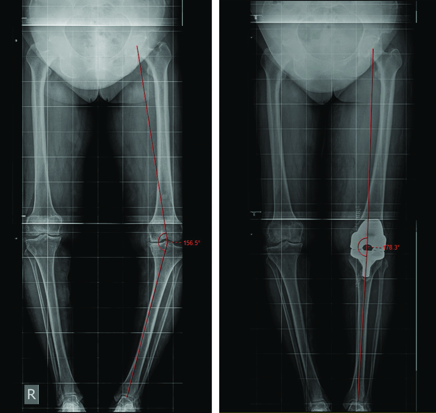 Preoperative and Postoperative X-ray measurement of Hip-Knee-Ankle ...