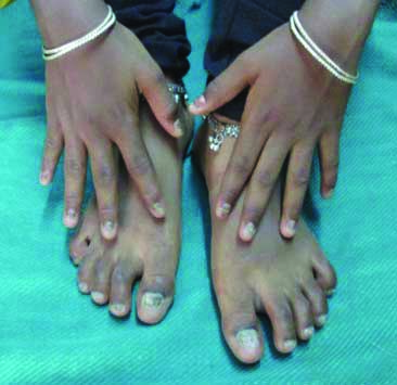 Childhood lichen planus with nail involvement: a case