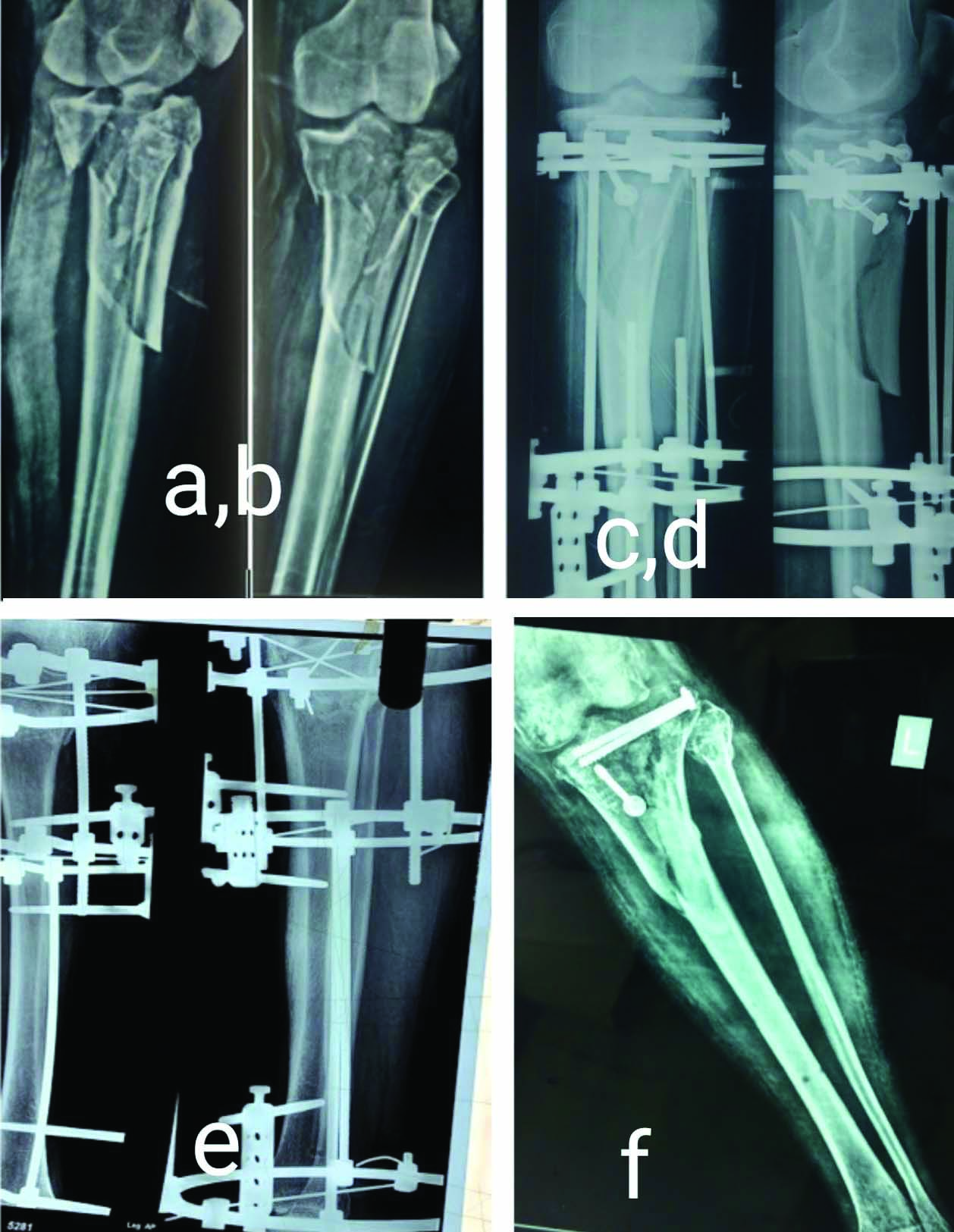 Orthopedic Fixation Ilizarov Ring External Fixator for Tibia