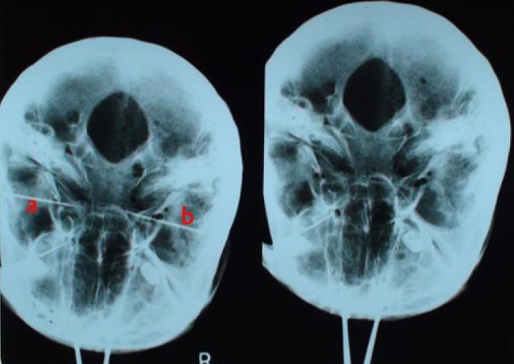 Foramen Ronde Foramen Rotundum And Ovale Radiology