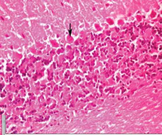 Cerebellar cortex of subgroup 2c showing complete loss of Purkinje ...