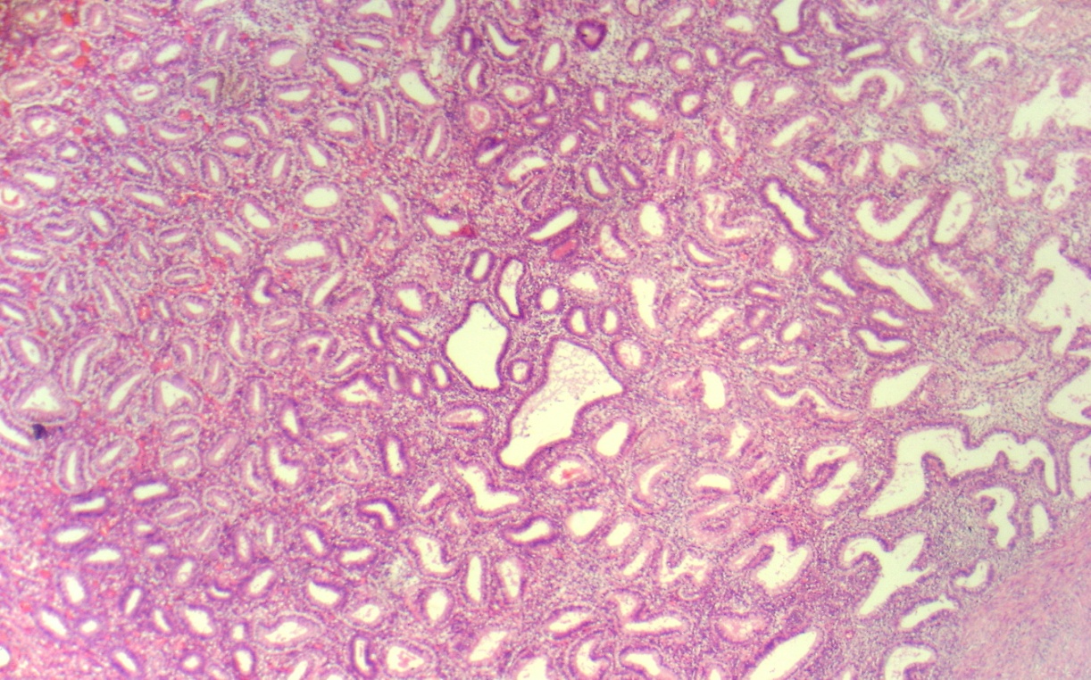 Pathology secretory endometrium Secretory adenocarcinoma