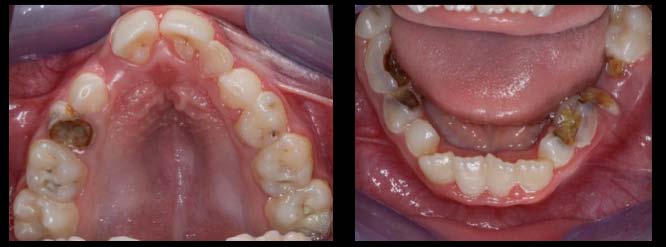 Rubinstein-Taybi syndrome: Dental manifestations and management