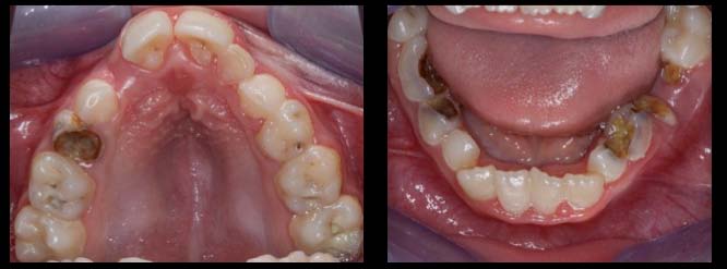 JCDR - Rubinstein Taybi Syndrome, Oro-facio-dental findings