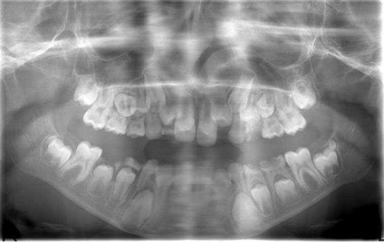 Rubinstein-Taybi syndrome: principal oral and dental disorders and  literature update
