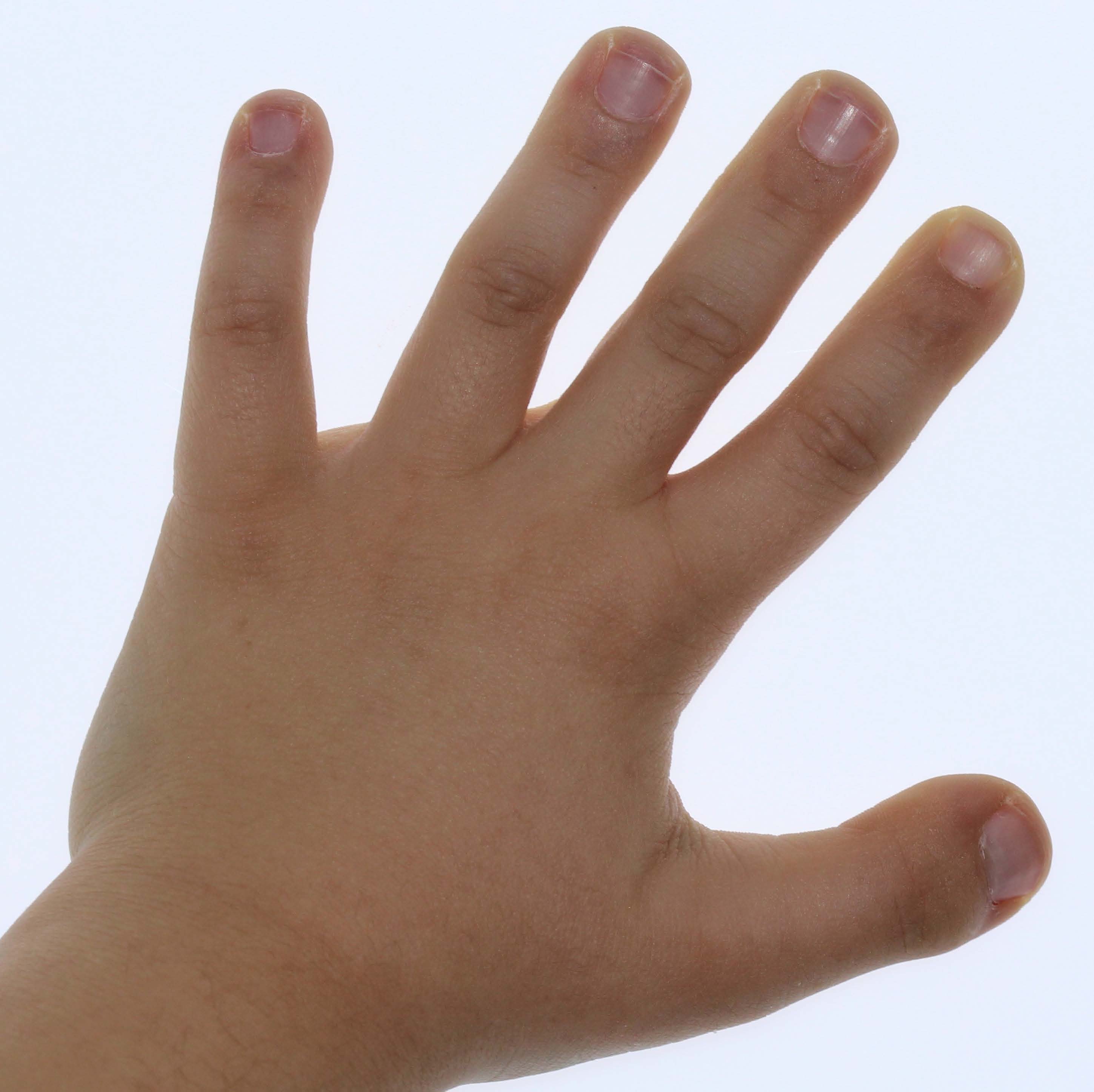 Rubinstein - Taybi Syndrome (Rubinstein syndrome, broad thumb