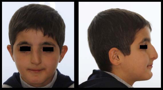 Rubinstein-Taybi syndrome in a Saudi boy with distinct features