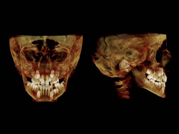 Dentocyclopedia - rubinstein taybi syndrome