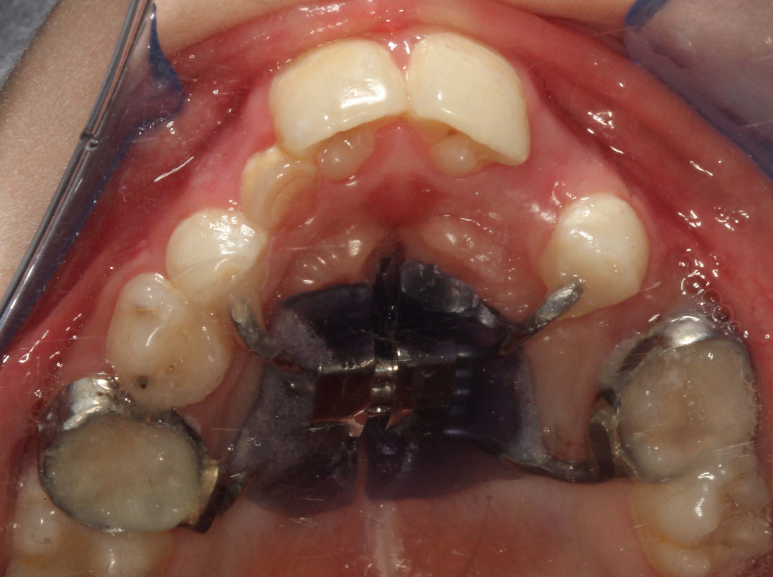 Rubinstein-Taybi syndrome: Dental manifestations and management