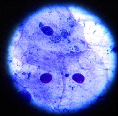 Budding micronucleus in the exfoliated buccal epithelial cell in ...