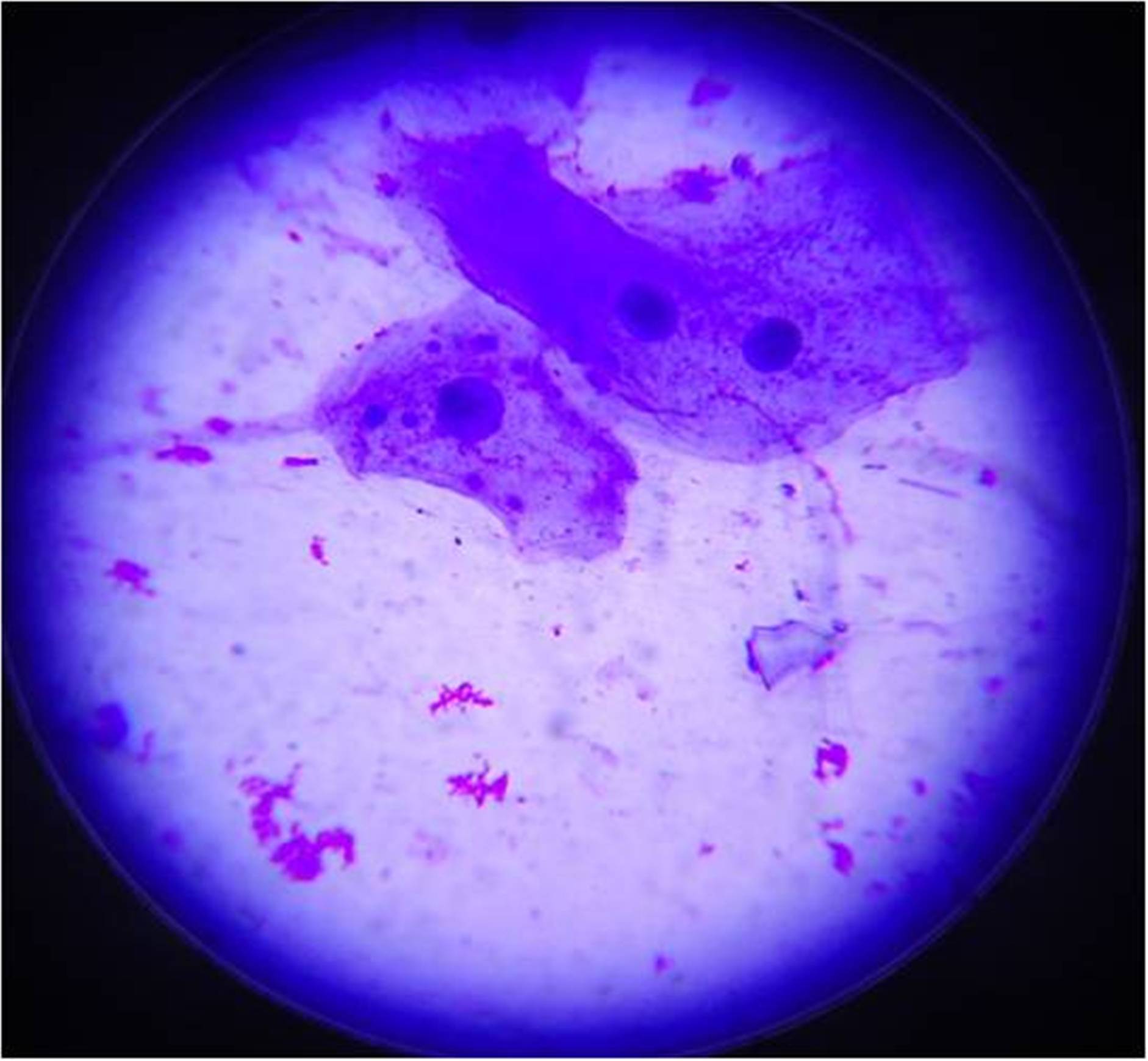 Exfoliated buccal epithelial cell with multiple micronuclei in ...