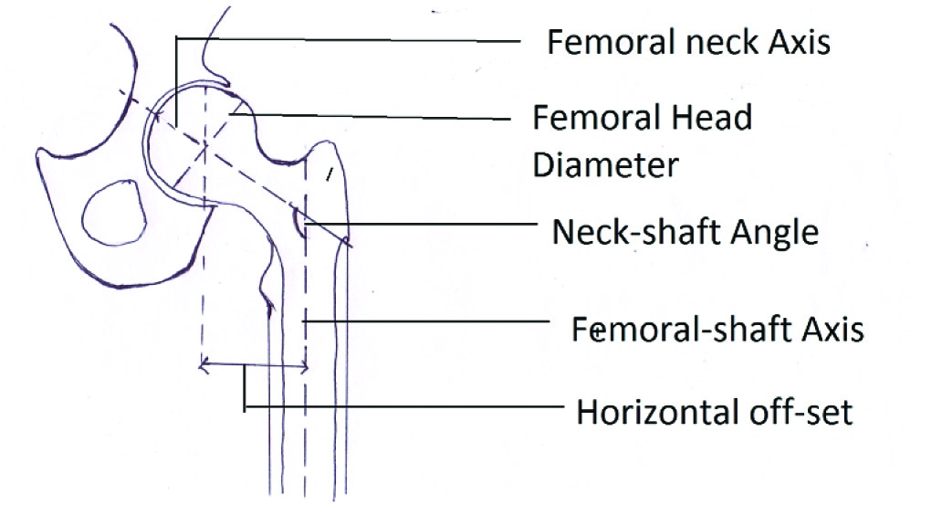 Femoral Neck Shaft Angle (NSA) - created by the intersection of two lines, ...