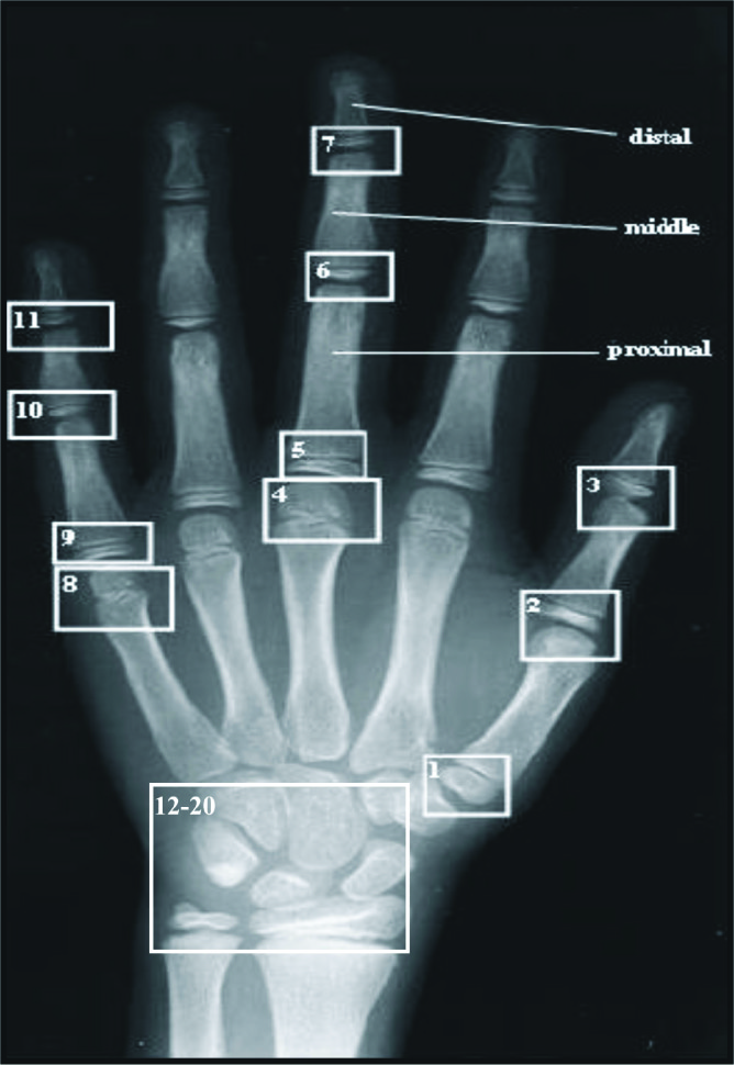 Bone Age Wrist Chart