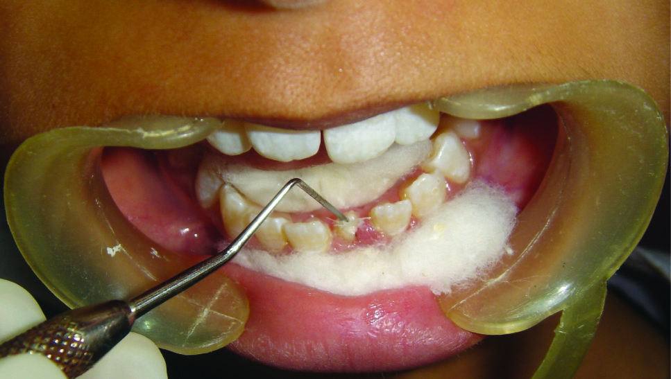 Radiograph showing ribbond inside canal