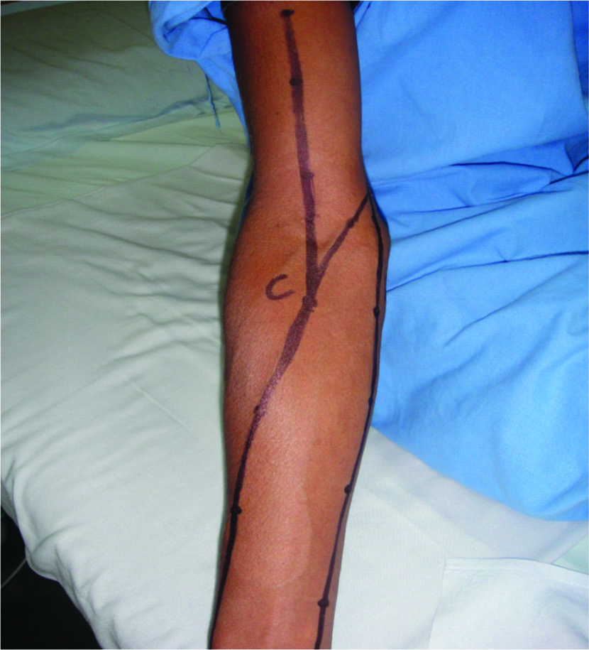 Doppler vascular mapping in Arterio Venous Fistula (AVF)