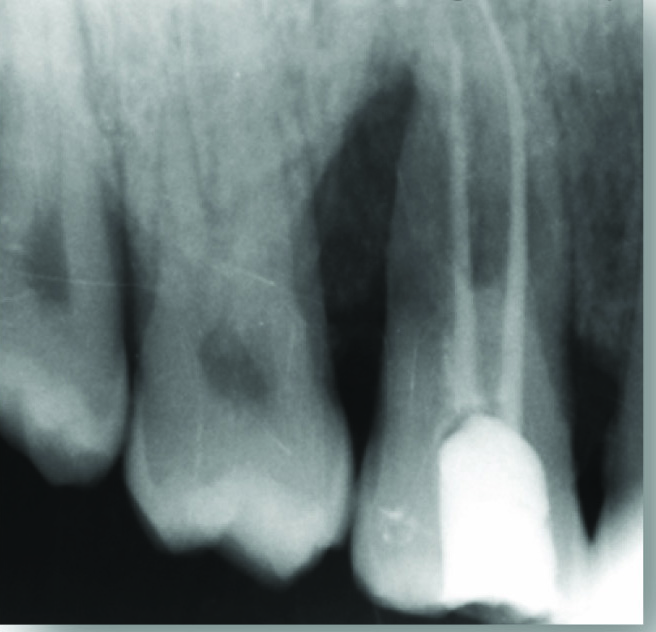 RVG after endodontic treatment in 16