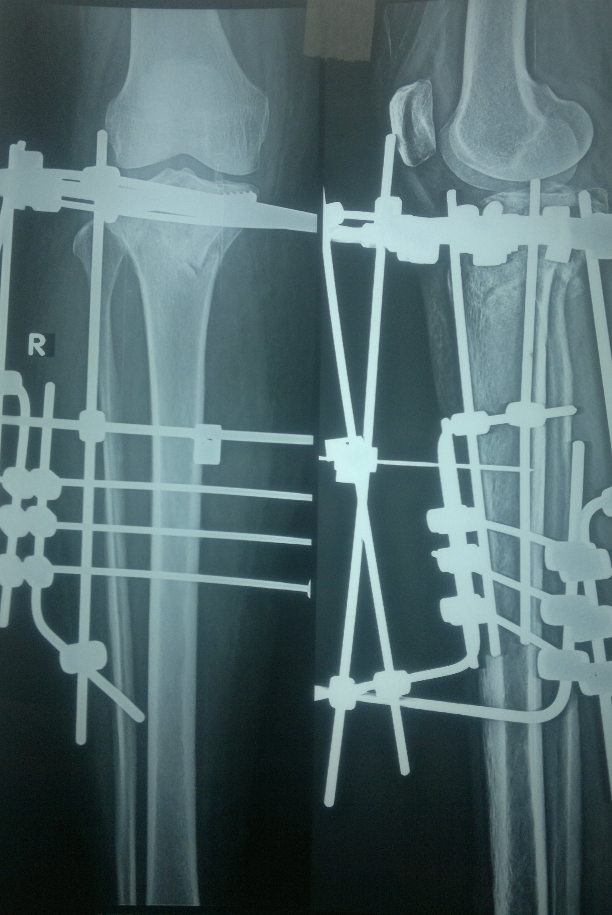 TIBIA BY HYBRID FIXATION