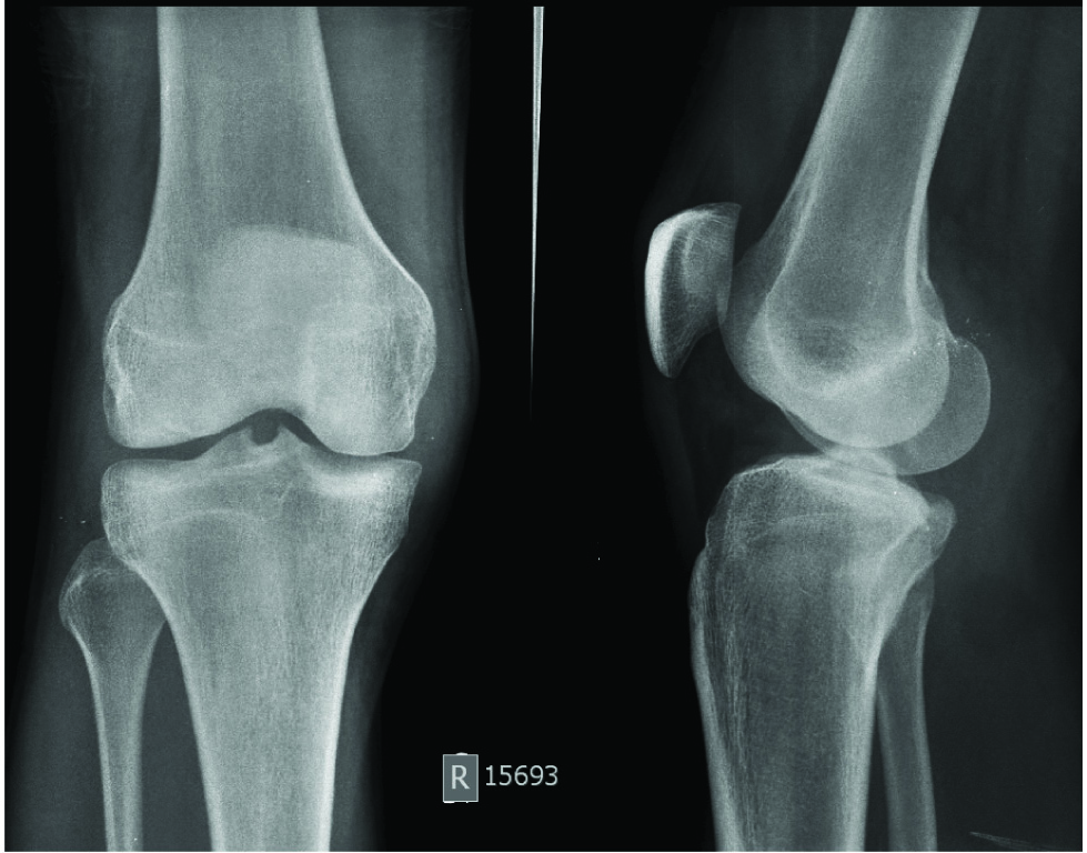 Jcdr Bone Contusions Bone Marrow Edema Mri Of Fractures