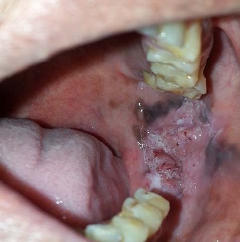 verrucous carcinoma palate